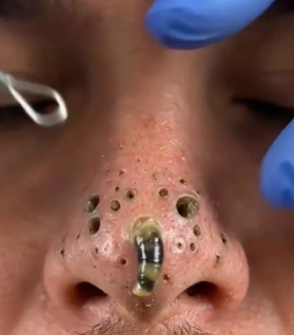 Why This Simple Blackhead Detail Has Everyone Talking