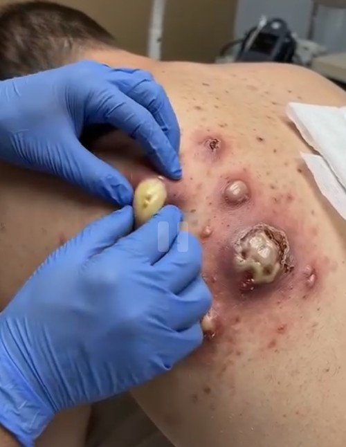 Doctors Stunned by Shocking Extraction From Severe Back Acne